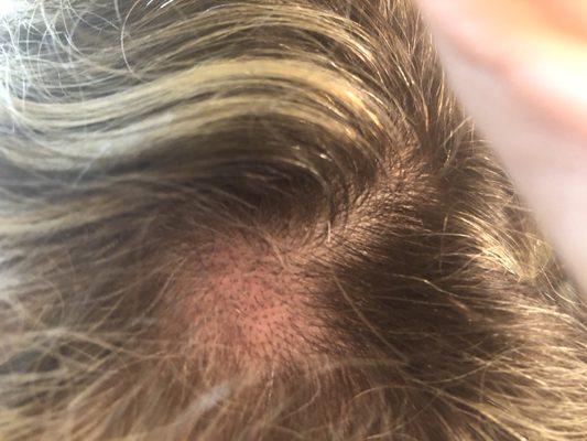 More Damaged blisters and bald spots - hair has Fallen off . It will probably take ten years to grow back