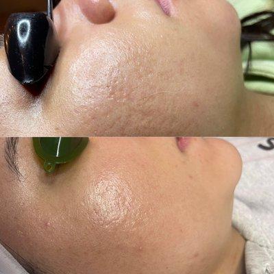 Microneedling Acne progress