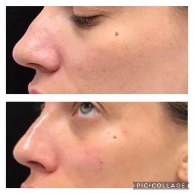 "Nose job" with just a little Juvederm filler!