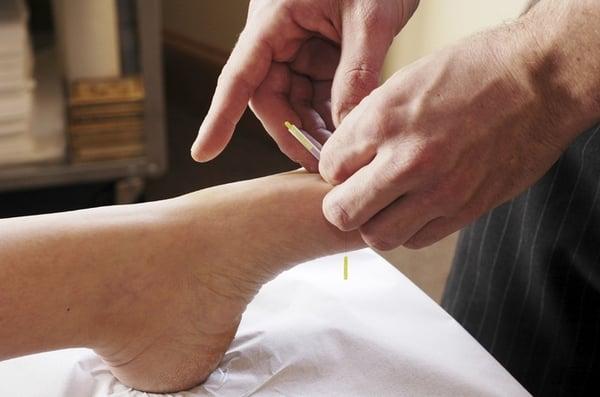 Acupuncture for health and wellness