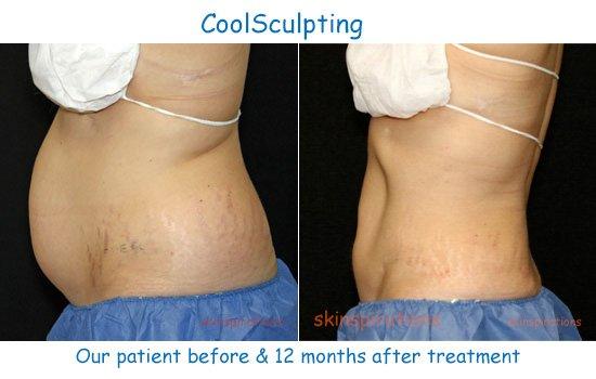 Our before & after results with nonsurgical body contouring and fat reduction