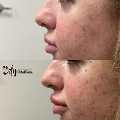 This client had her lips re-enhanced by Dr. Quach, for a fuller and evenly-shaped lips!