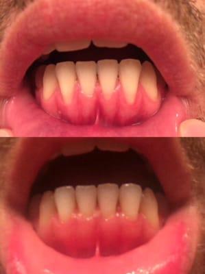 Before and after of my gum graft surgery.