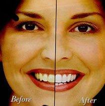 Zoom! Whitening Winter specials! Only $199!