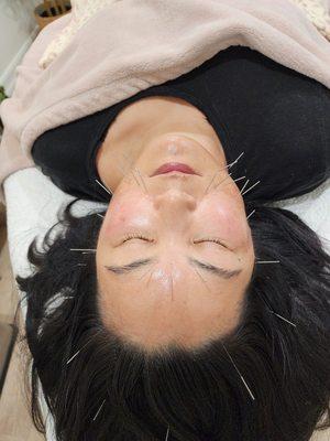 Facial acupuncture