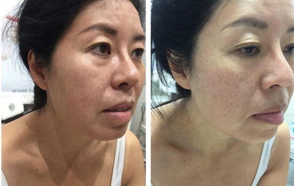 Skin brightening and lifting after BDR Microneedling facials