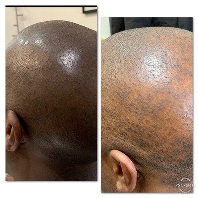 Fill in light areas  from alopecia with SMP- scalp micropigmentation .