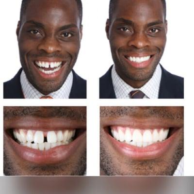 Veneers before and after