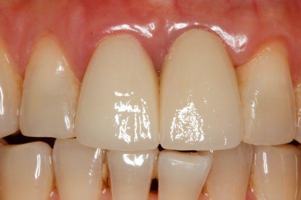 Broken tooth successfully replaced by a dental implant and crown