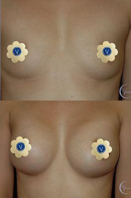 Breast Augmentation