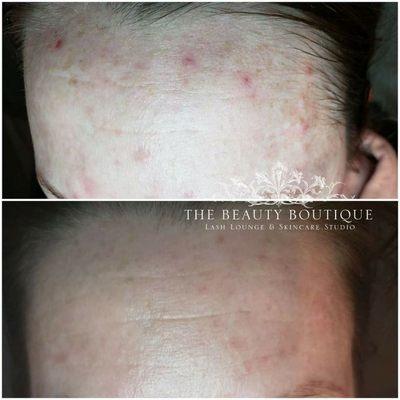 Acne/Compromised Barrier Repair