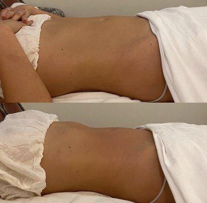 Before and after lymphatic massage