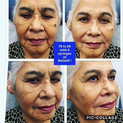 We have many patients in their 70's and 80's (as well as 20s and 30's!!) 70 is the new 50.  30 is the new and better looking 24!!