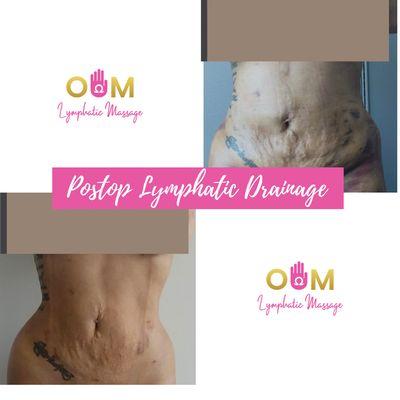 Postop lymphatic drainage after surgery