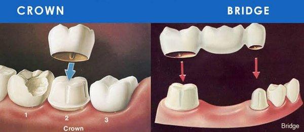 Emergency Dental  Crown & Bridge