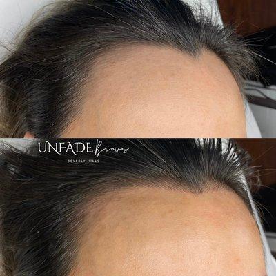 Hairline design and Microblading for residing hairline, hair loss or scars