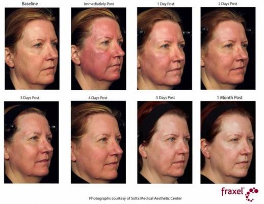 FDA-approved, Fraxel aims to reduce the appearance of fine lines and wrinkles, skin pigmentation, sun damage and acne