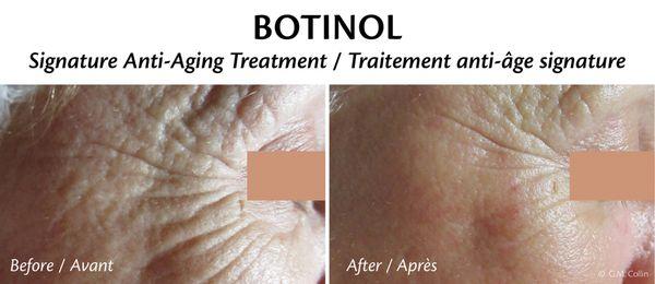 Botox treatment without injection