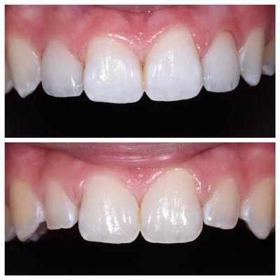 Veneers on two side teeth