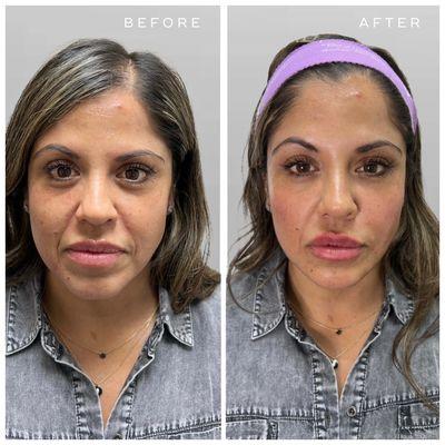 Before and after dermal filler