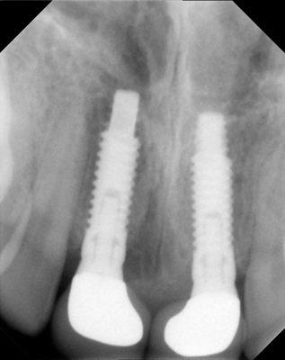 2 dental implants in upper front of mouth