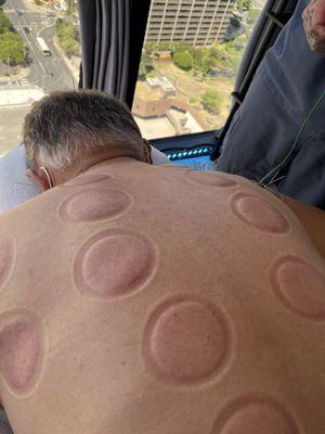 After Cupping