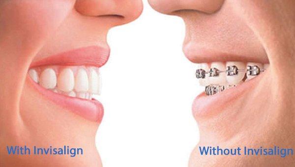 Invisalign vs Braces