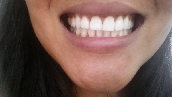 Just got my teeth whitened!!