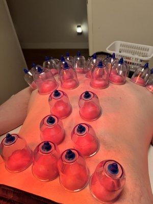 Cupping