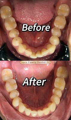 invisalign