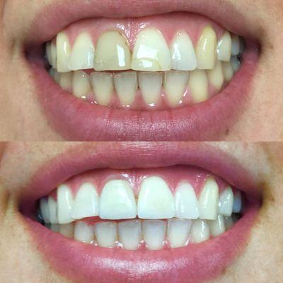 Zoom whitening and veneer restorations. Before and after results