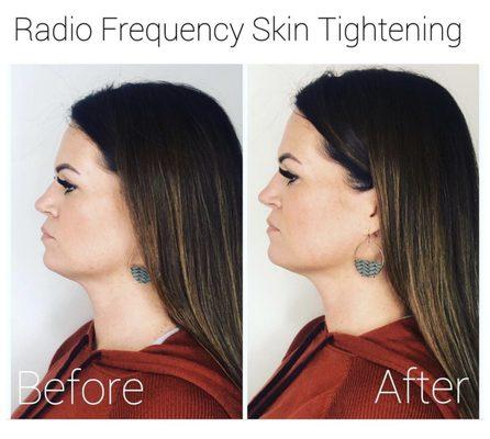 Radio Frequency Skin Tightening - Before & After