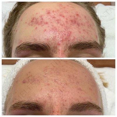 Before and after 3 Diamond Glow facials