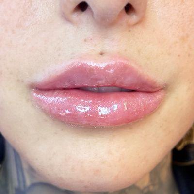 Immediately after lip filler with Master Injector July