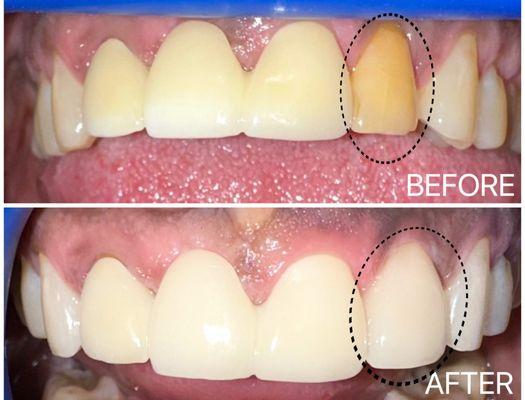 Before and After pics for new Veneer work on tooth #10