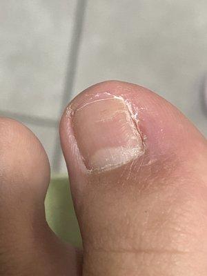 Ingrown nails before and after