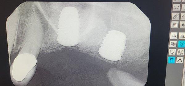 placed implants for future Teeth