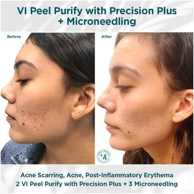 How VI Peel and Micro-needling can be a great combination do apply for your skin treatment