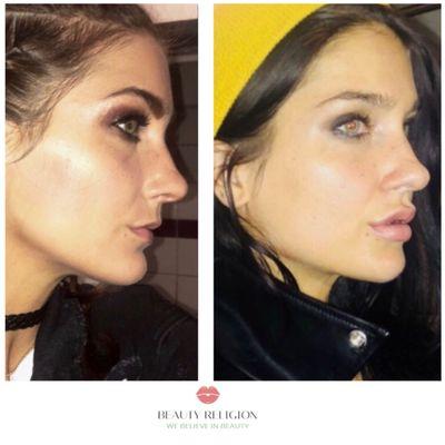 Before and after Lip injections with #lipflip on very thin upper lip