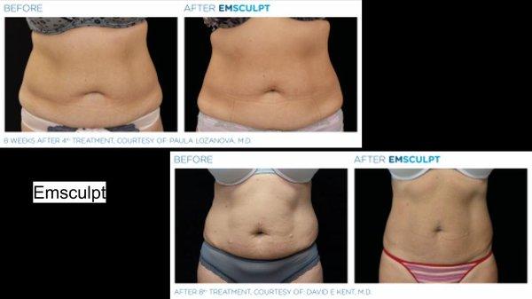 Emsculpt for Fat Burn and Muscle Building