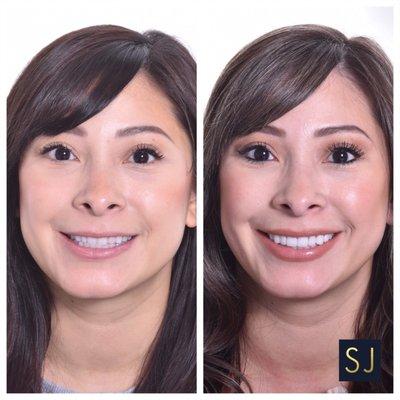 Top 8 veneers for flawless smile makeover by: Sarah Jebreil DDS, AAACD