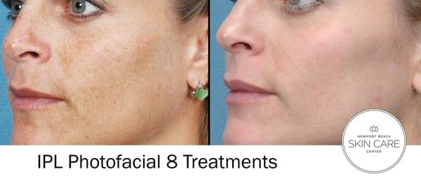 IPL for hyper-pigmentation, age spots, sun spots, melasma