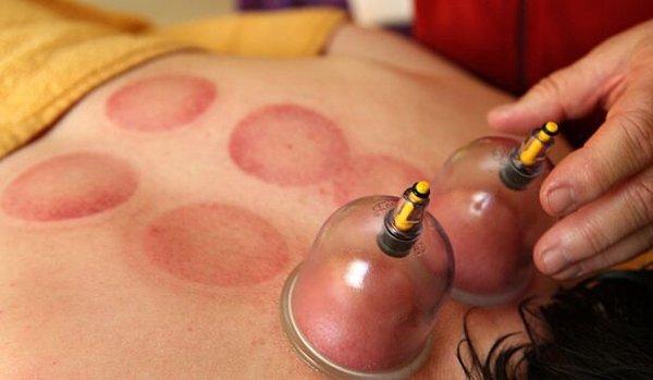 Myofascial Cupping Massage