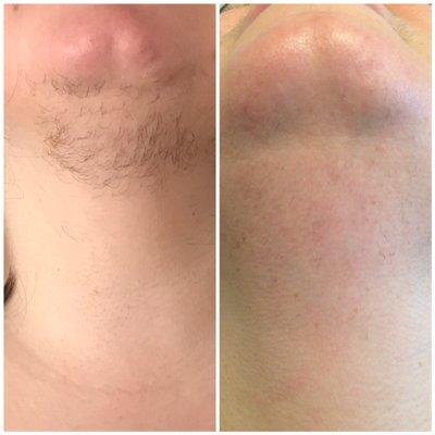 Laser Hair removal Chin