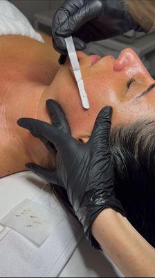 Dermaplaning