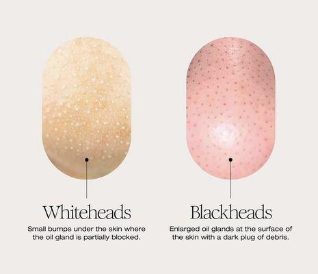 Whiteheads Vs Blacheads