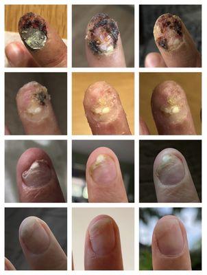 Fingernail growth after emergency reconstructive surgery.