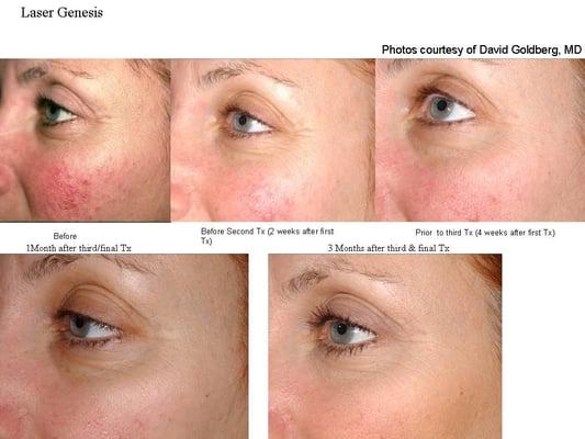 Laser Genesis Before&After