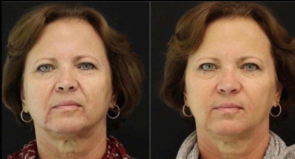 Before and after photos of Injectable Dermal Filler to the Nasolabial folds, Cheeks, Marionettes