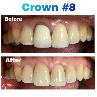 Failing crown with receding gum line causing food trap and bad breath replaced with a functional crown. Another happy patient!